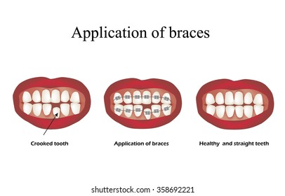 The use of braces. Crooked teeth. Orthodontics. Infographics. Vector illustration on isolated background.