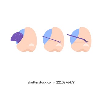 using pore pack, Comedone extractor, Blackhead tweezer to remove blackheads from the skin of the nose. tools and methods for cleaning or removing commodes. concept illustration designs. graphic elemen