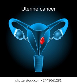 Uterine cancer. Cross section of a human uterus with Endometrial tumor. female reproductive system. Vector illustration like X-ray image. Reproductive health.