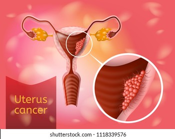 Uterine Cancer Realistic Vector Poster or Chart with Cancerous Tumor Cells on Endometrium Tissue of Uterus. Most Common Oncological Disease of Woman Reproductive System Anatomical Illustration