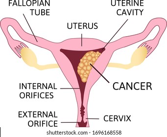 Uterine Cancer Vector Poster or Chart with Cancerous Tumor Cells on Endometrium Tissue of Uterus. Most Common Oncological Disease of Woman Reproductive System Anatomical Illustration. 