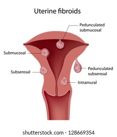 Uterine Fibroid