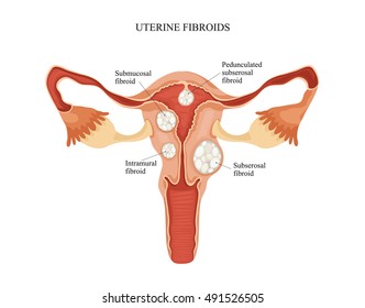 Uterine Fibroid