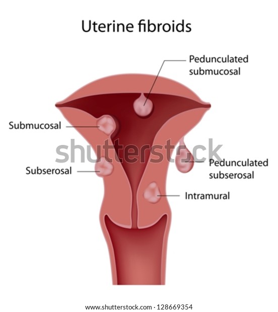 Uterine Fibroid Stock Vector Royalty Free 128669354