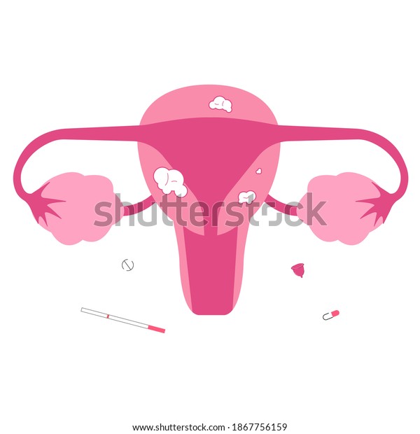 Uterine Fibroid Female Reproduction Organ Problems Stock Vector