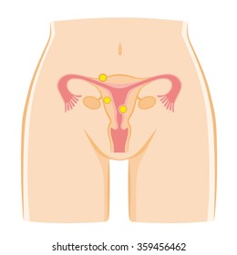 Uterine Fibroid Of Illustrations.