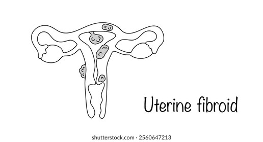 Uterine fibroid. Local benign proliferation of muscle and connective tissue elements, which leads to the formation of a node in the uterine area. A simple line illustration on a medical theme.