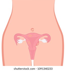 Uterine Fibroid Vector Illustration. Gynecology Problem. Tumor In Female Reproductive Organ