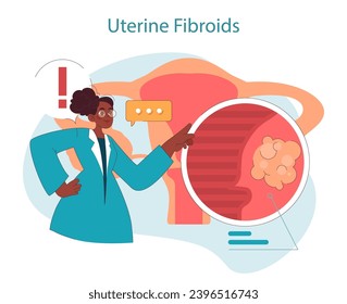 Fibromas uterinos. El médico ilustra el estado de los fibromas uterinos, acercándose a la zona afectada con lupa. Salud de la mujer y educación médica. Ilustración vectorial plana