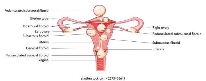 Uterine fibroids Female leiomyomas reproductive system uterus diagram with inscriptions in Latin text. Human anatomy medical illustration isolated internal organs location scheme, cervix flat icon