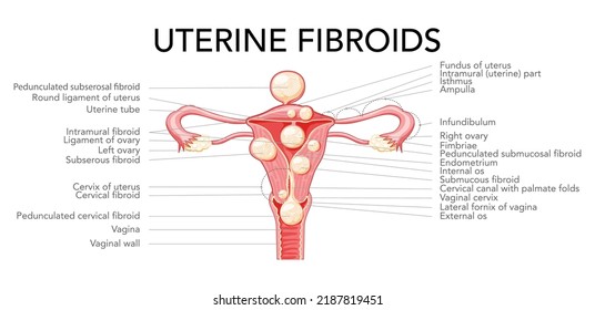 Uterine Fibroids Female Leiomyomas Reproductive System Stock Vector