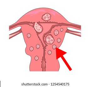 Uterine Fibroids. With A Pointer To Myoma And Pain Points