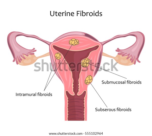 Fibroïdes Utérins Illustration Vectorielle Création à Image