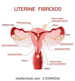 Uterine fibroids.A schematic illustration of the uterus, female reproductive system diseases.Female reproductive system.Human anatomy