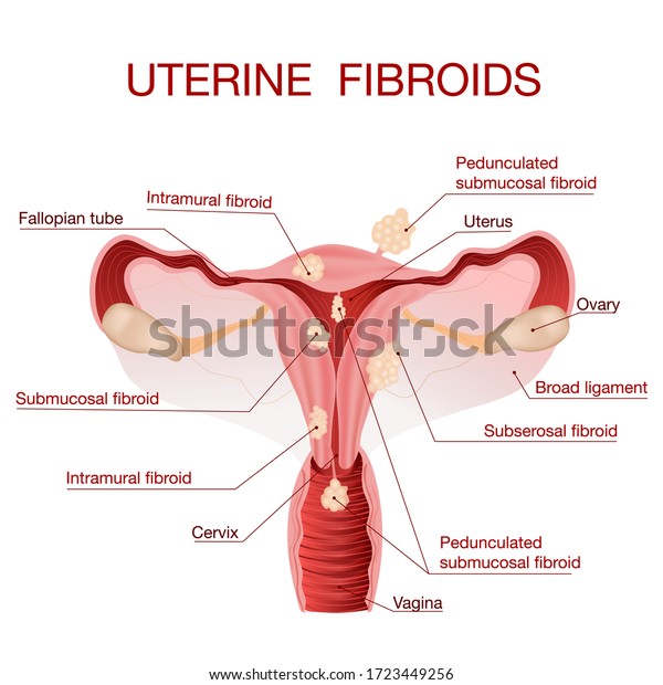 Was bedeutet plumper uterus