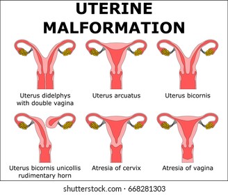 23 Uterine Malformation Images, Stock Photos & Vectors | Shutterstock