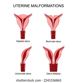 Malformaciones uterinas. Unicornio, difamación, bicornuato y útero de septiembre. Afiche vectorial para uso médico