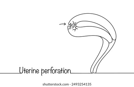 Uterine perforation. Rupture of the uterine wall due to medical intrauterine procedures. Serious complication resulting from treatment. Hand drawn medical illustration. Vector illustration.