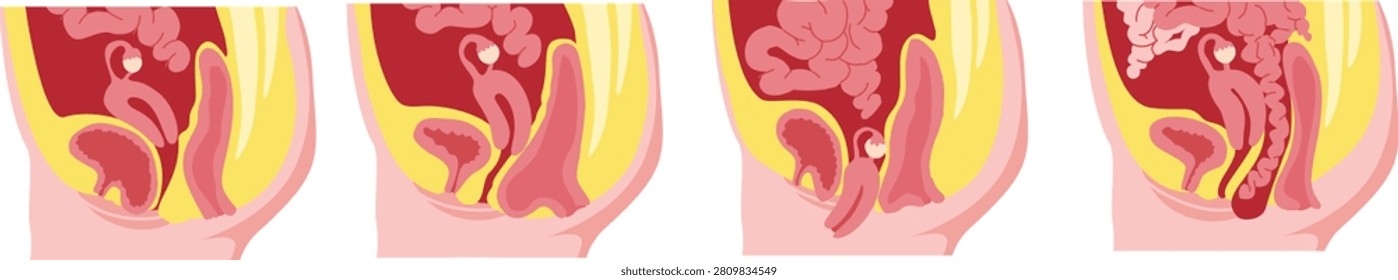 Uterine prolapse stages vector illustration set with anatomical diagram showing pelvic organ prolapse degrees inside uterus