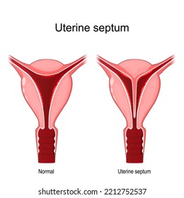 Septum uterino. Comparación y diferencia entre útero normal y anormal. sistema reproductivo femenino. Malformaciones uterinas. Ilustración del vector