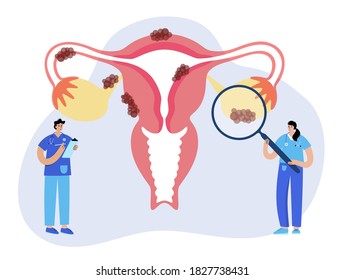 Uterus Anatomy, Endometriosis. Cancer And Tumor Disease. Woman Health Medicine. Doctor Gynecologist Appointment, Consultation, Help, Treatment. Female Reproductive System Flat Vector Illustration