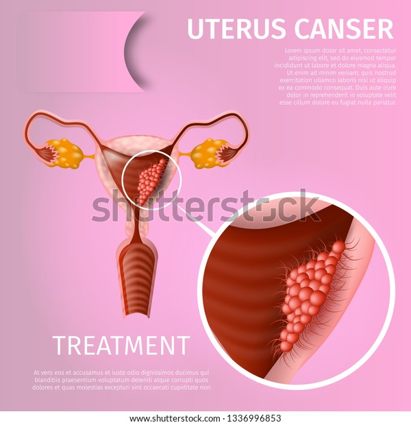 子宮がん 治療 女性の生殖系の腫瘍学的障害 子宮内膜組織上にがん性腫瘍細胞を持つ医療用バナーチャート ベクター画像のリアルなイラスト スペースのコピー のベクター画像素材 ロイヤリティフリー