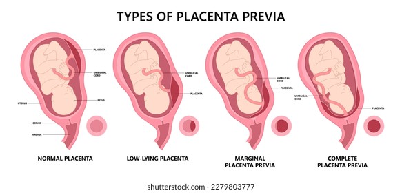 uterus contraction baby of vasa fetal infant born c section nuchal cord twins fetus defect vessels funic labor growth low lying birth fluid of test increta cervix Bilobed sac neck knotted preterm