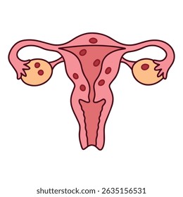 Uterus with endometriosis shown as red lesions outside the uterine lining. Used in gynecology, medical education, and awareness of chronic pelvic condition
