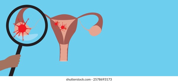 Uterus with malignant tumor as oncology concept, flat vector stock illustration or copy space template with cervical cancer or ovarian cancer