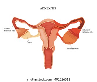 Adnexal Images Stock Photos Vectors Shutterstock