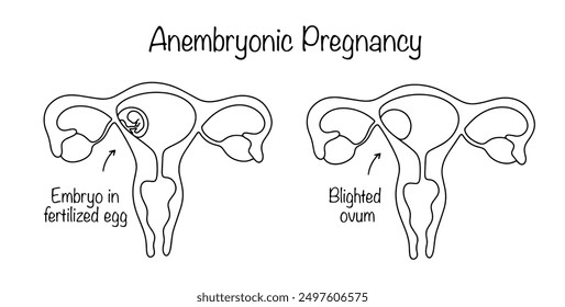 The uterus with pregnancy occurring and the presence of an embryo and the uterus with the absence of an embryo in the fertilized egg. Pathology of pregnancy. Isolated vector on white background.