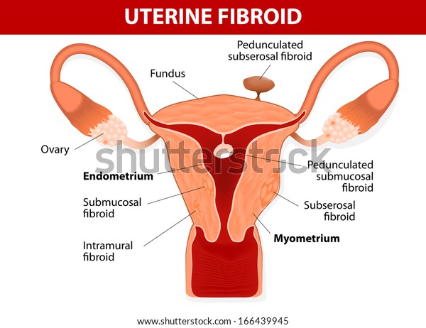 Uterus & types of fibroids. Uterine\
fibroids are benign tumors. They are many times denser than normal\
myometrium. Vector\
illustration