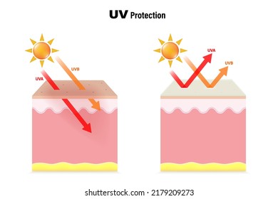 UV Protecttion. The difference between skin without sunscreen lotion and skin with sun protection lotion. 
UVA and UVB radiographs of skin damage.