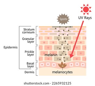 Die UV-Strahlung der Sonne führt zu dunklem Fleck durch Melanin. menschliche Hautschicht und Zellgrafik. Beauty- und Gesundheitskonzept 