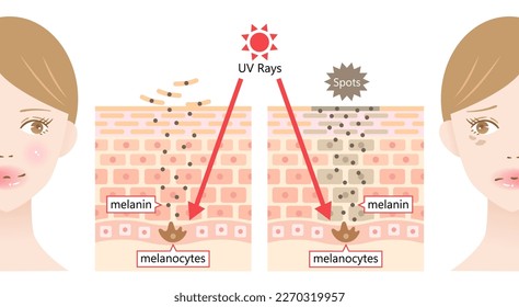 la radiación UV del sol induce un punto oscuro por la melanina en la cara de las mujeres jóvenes. Capa de piel humana y célula antes de la ilustración. Concepto de belleza y atención de la salud 
