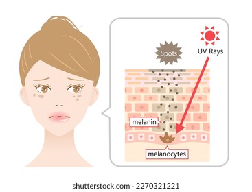 la radiación ultravioleta del sol induce a la melanina a mantener un punto oscuro en la cara de las mujeres jóvenes. Capa de piel humana e ilustración celular. Concepto de belleza y atención de la salud 
