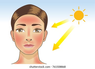 UV ray from sun made the redness appear on woman facial and neck skin. Illustration about danger of Ultraviolet.
