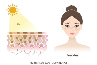 UV rays penetrate into the epidermis skin layer, freckles woman face, result of overproduction of melanin, small flat brown spots vector illustration isolated on white background. Skin care concept.