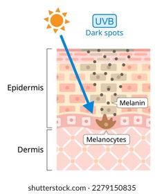 UVB damages to human skin. Ultraviolet B (UVB) has a shorter wavelength. It is associated with dark spot. Beauty and heath care concept