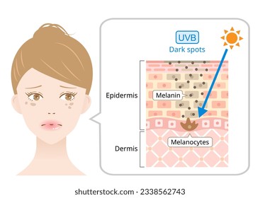 UVB radiation penetrate into the skin on woman’s face that is associated with dark spot.  Beauty and heath care concept