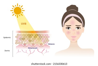 UVB rays penetrate into the epidermis skin layer, damage woman face, resulting in a burn, inflammation, aging, wrinkle, red spots vector isolated on white background. Skin care concept illustration. - Shutterstock ID 2156330613