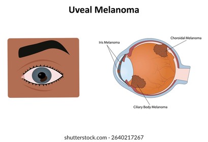 Uveal melanoma in the eye vector illustration