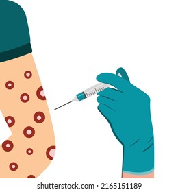 Vaccination against monkeypox virus in the shoulder and arm with a syringe. Eruption on the body. Monkey Pox virus disease symptoms on hands rash infection. Vector illustration isolated.