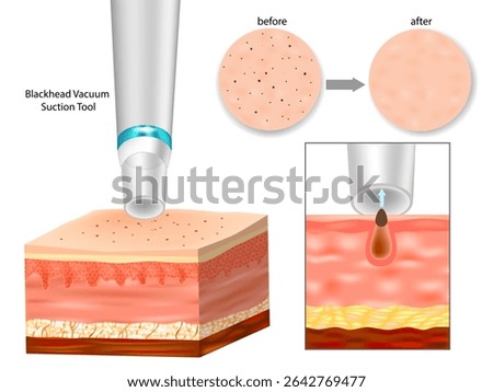 Vacuum Pore Cleaner Extracting Blackhead – Before and After Skin Comparison. Blackhead Removal Process Using Vacuum Suction Tool