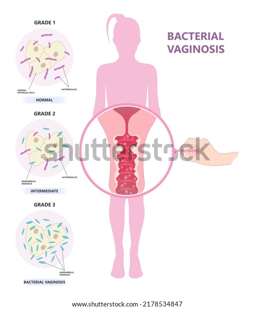 Sex With Bacterial Vaginosis