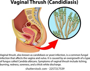 Vaginal Thrush (Candidiasis) infographic with explanation illustration