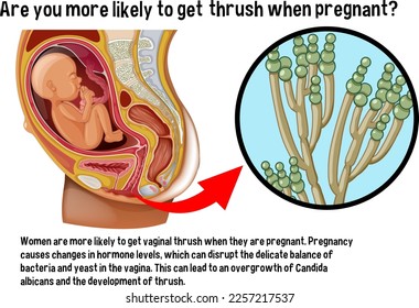 Vaginal thrush during pregnancy infographic with explanation illustration