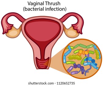 Vaginal Thrush on White Background illustration