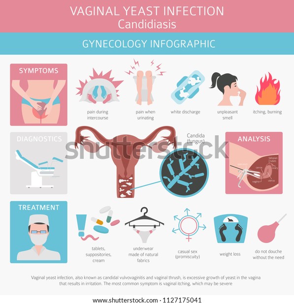 膣酵母感染 カンジダ症 Ginecologicalの医学デザインのインフォグラフィック ベクターイラスト のベクター画像素材 ロイヤリティフリー