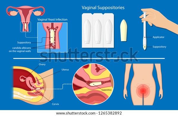 medicación vaginal de levadura medicación vaginal de levadura